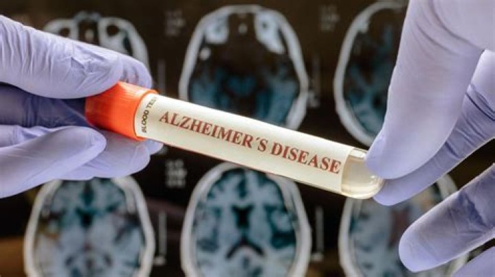 Blood test is 94 per cent accurate at identifying early Alzheimer's disease