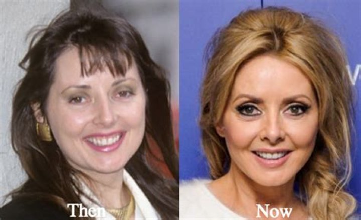 Carol Vorderman Surgery: A Comprehensive Overview