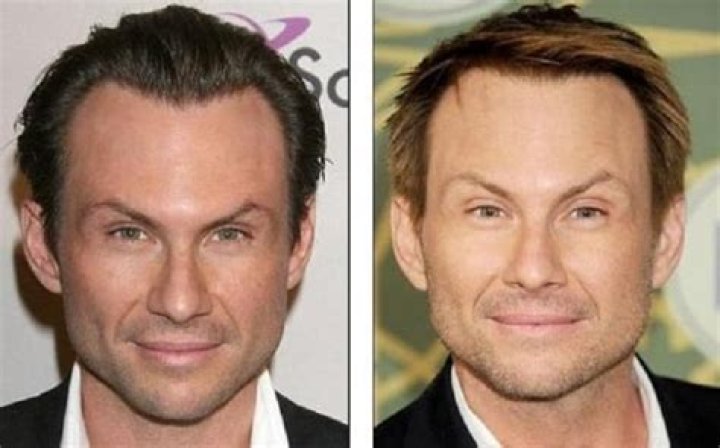 Christian Slater's Plastic Surgery Journey: A Candid Review