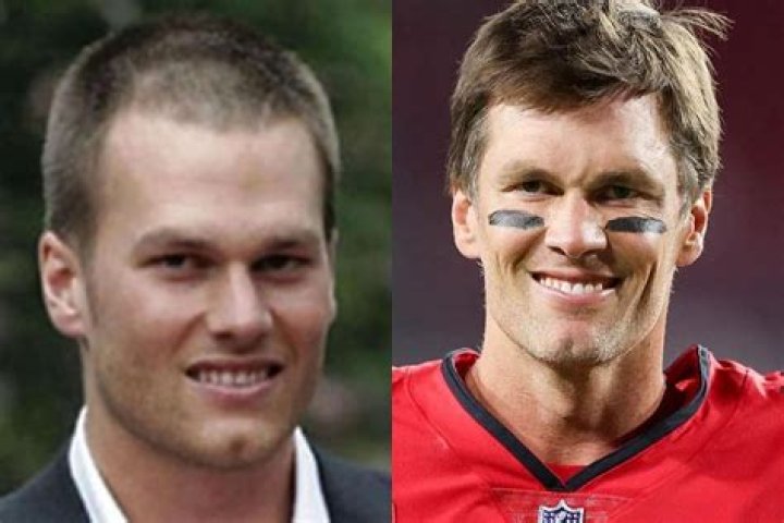 Does Tom Brady have hair plugs? Breaking down QB’s remarkable comeback from baldness