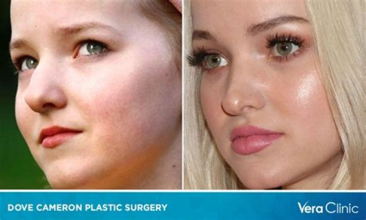 Dove Cameron Plastic Surgery: A Comprehensive Analysis