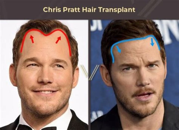 Has Chris Pratt Received a Hair Transplant?