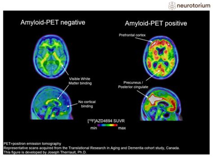 Having a PET scan | Alzheimer's Society