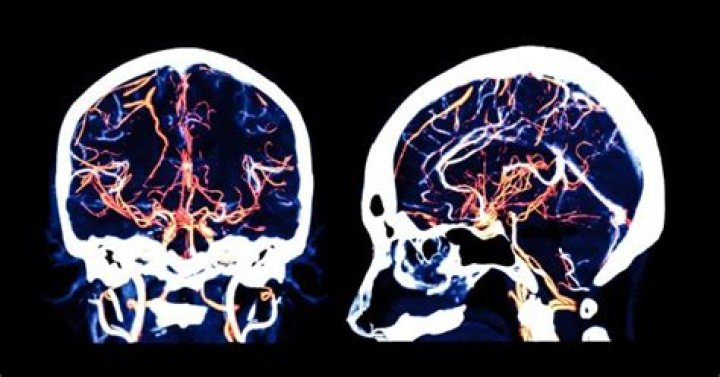 Hope for first treatment for strokes linked to dementia