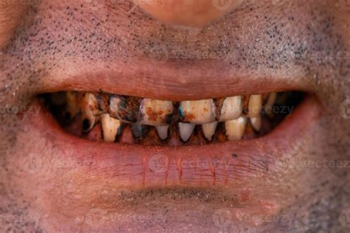 Horrible Teeth Pics: Understanding Dental Health Through Visuals