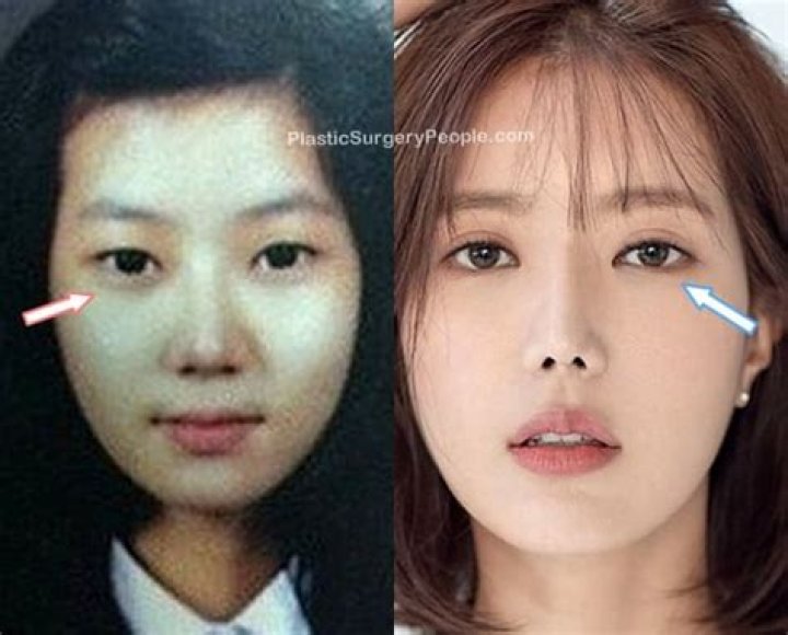 Im Soo-Hyang Plastic Surgery Before And After: A Comprehensive Overview