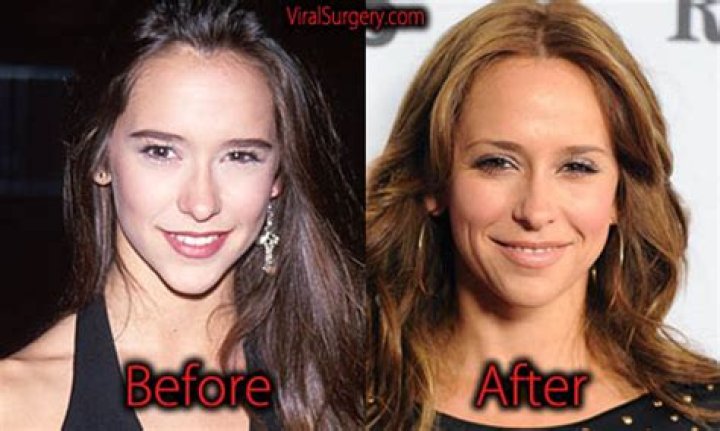 Jennifer Love Hewitt Chirurgie