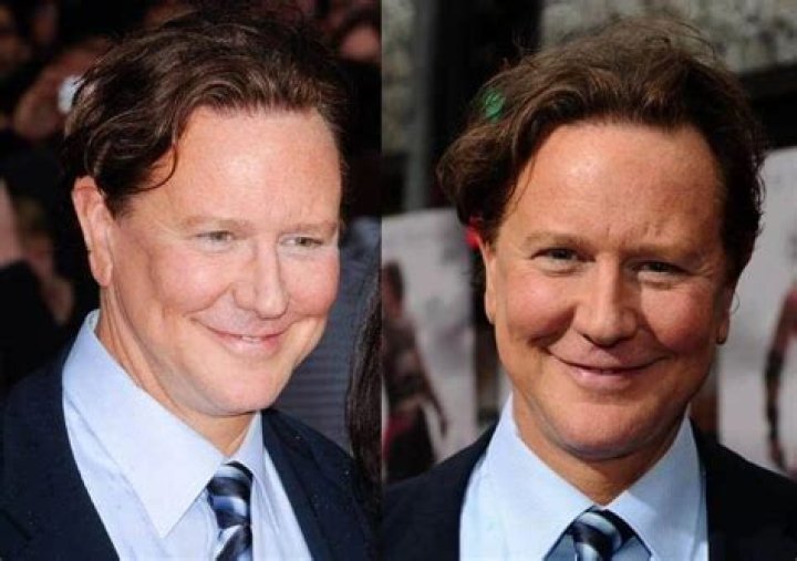 Judge Reinhold And His Journey Through Plastic Surgery: What You Need To Know