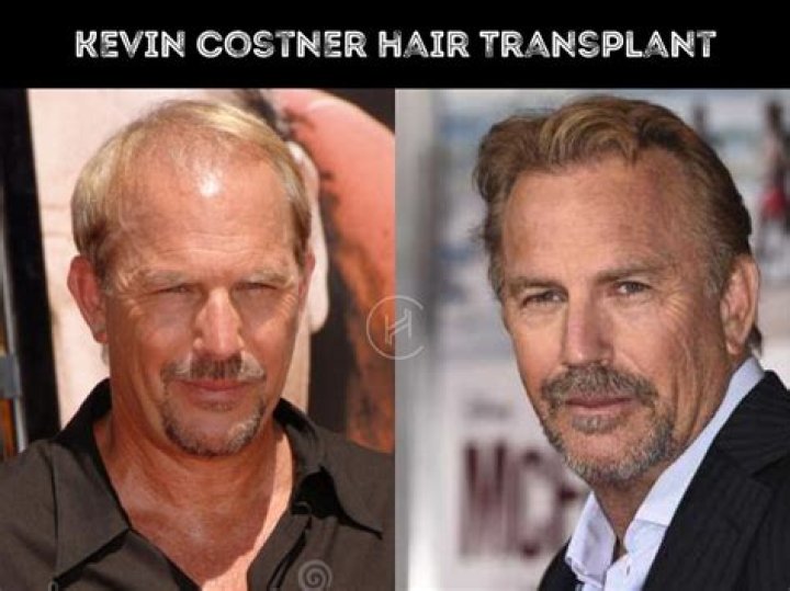 Kevin Costner Must Have Received Plastic Surgery!