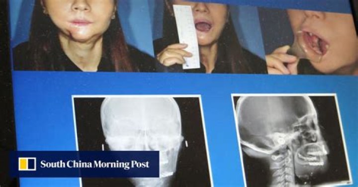 Manila bus survivor Yik Siu-ling recovering in Taiwan after operation