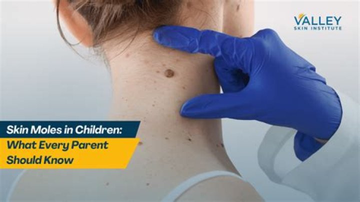 	Monitor moles in children	