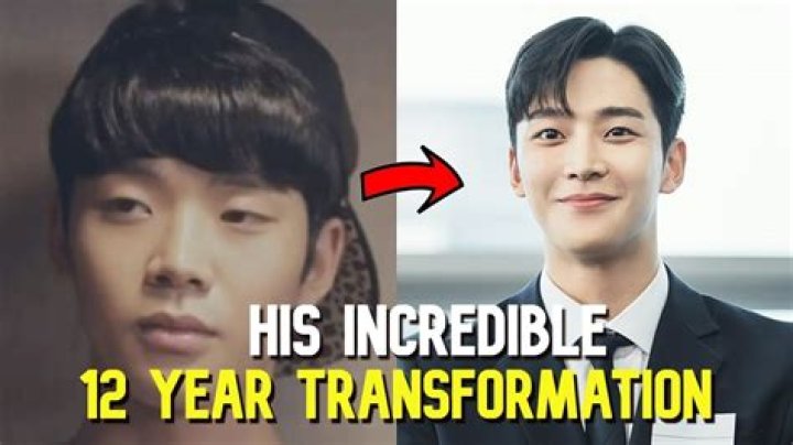 Rowoon Chirurgie