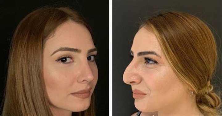 Rym Avant Chirurgie