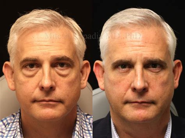 	SILICONE SURGERY WILL PUMP YOU UP	