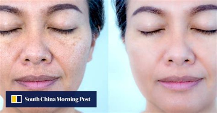 Skin ‘whitening’ risks: why you shouldn’t use lightening creams and what you can try instead