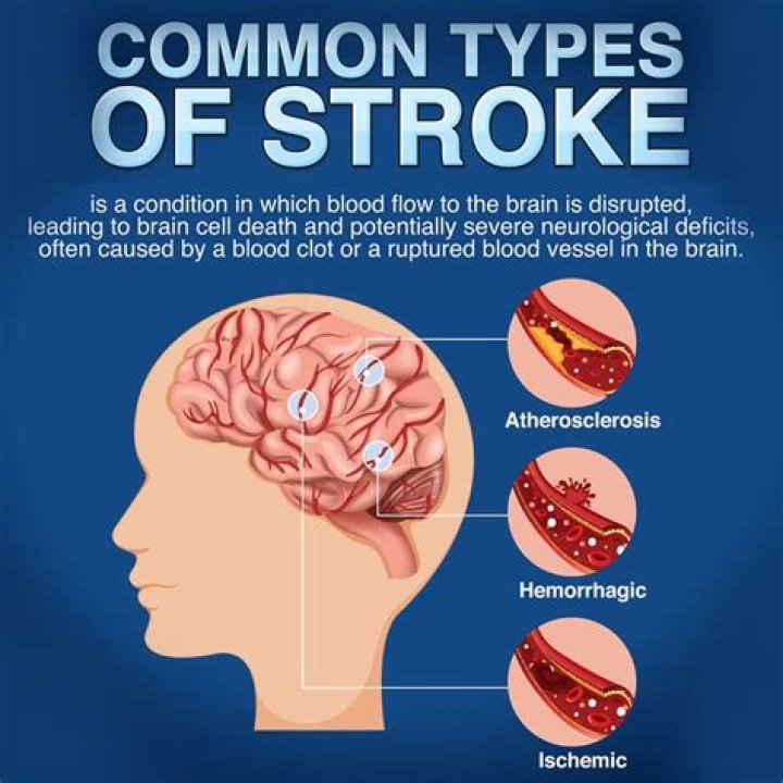 Understanding Harry Connick Jr.'s Health Journey: The Impact Of Stroke