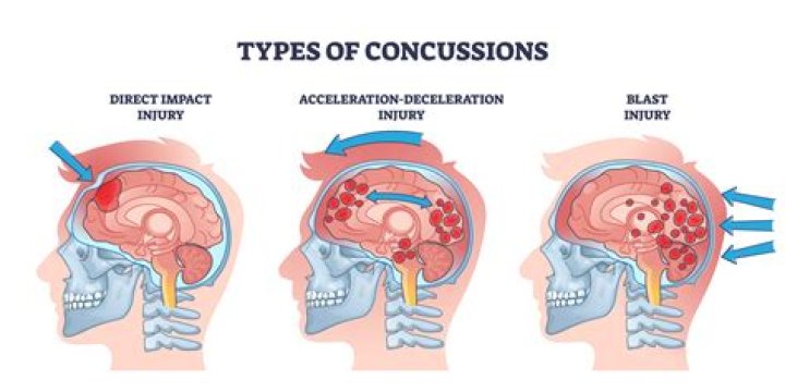 Understanding The Impact Of Concussions: Britt Donaldson's Journey