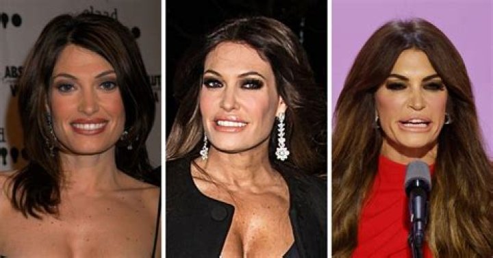 Unveiling The Truth Behind Kimberly Guilfoyle's Face Surgery
