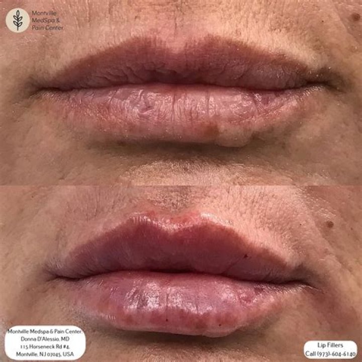 Valley women claim botched lip injections caused severe infection