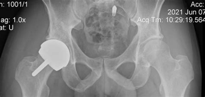 Why athletes find themselves needing hip surgery in midlife, and how hip resurfacing gives them a second shot at sporting glory